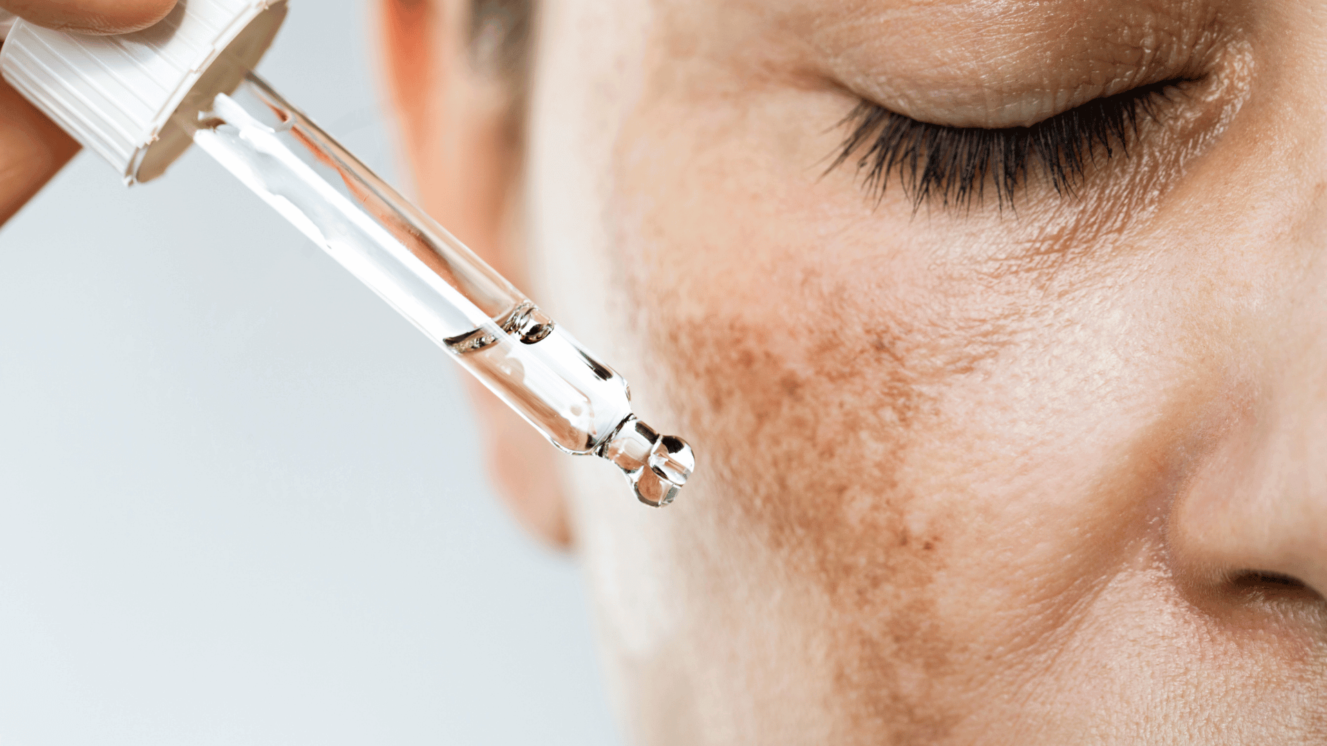 Melasma en Torremolinos · Centro Ubud