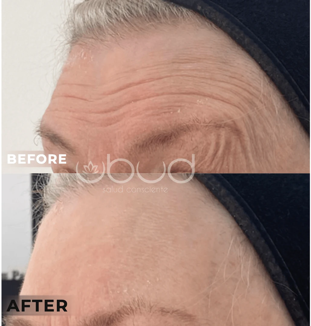 Antes y después de arrugas en Centro Ubud Torremolinos