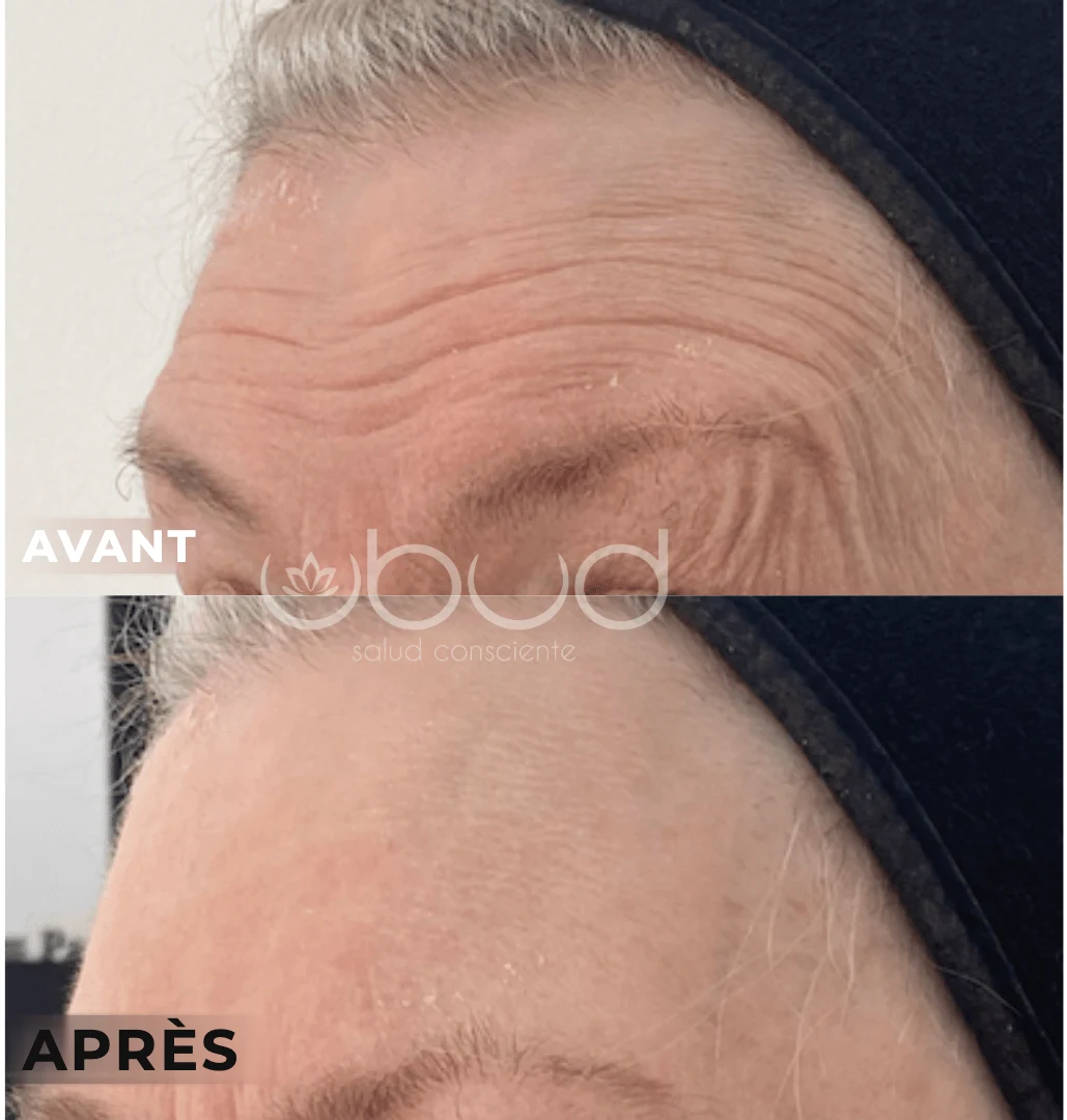 Antes y después de arrugas en Centro Ubud Torremolinos