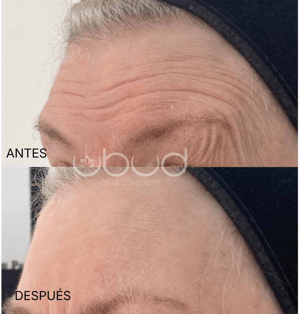 Antes y después de arrugas en Centro Ubud Torremolinos