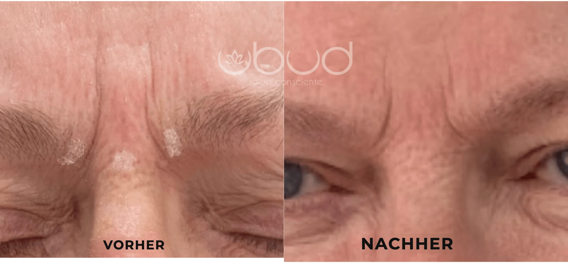 Antes y después de arrugas del entrecejo en Centro Ubud Torremolinos