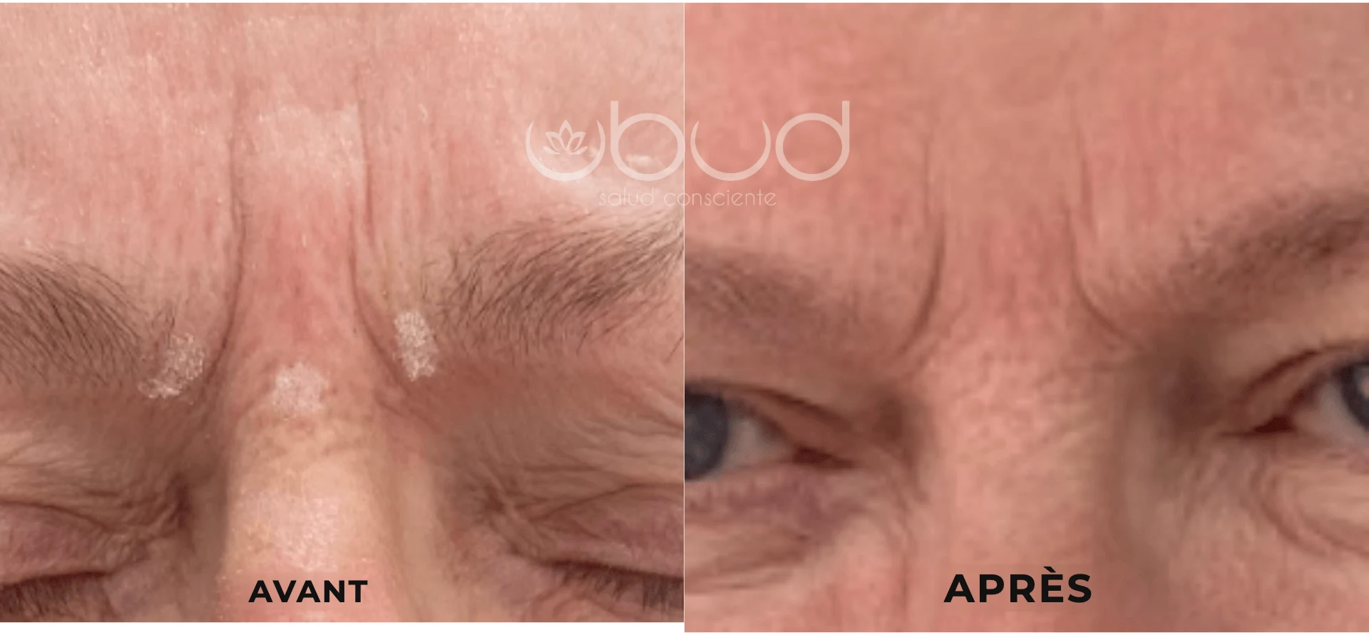 Antes y después de arrugas del entrecejo en Centro Ubud Torremolinos