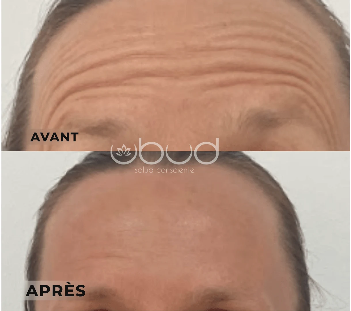 Antes y después de arrugas de la frente en Centro Ubud Torremolinos