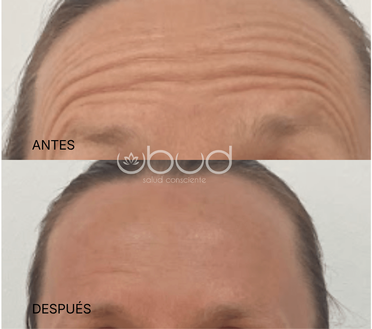 Antes y después de arrugas de la frente en Centro Ubud Torremolinos