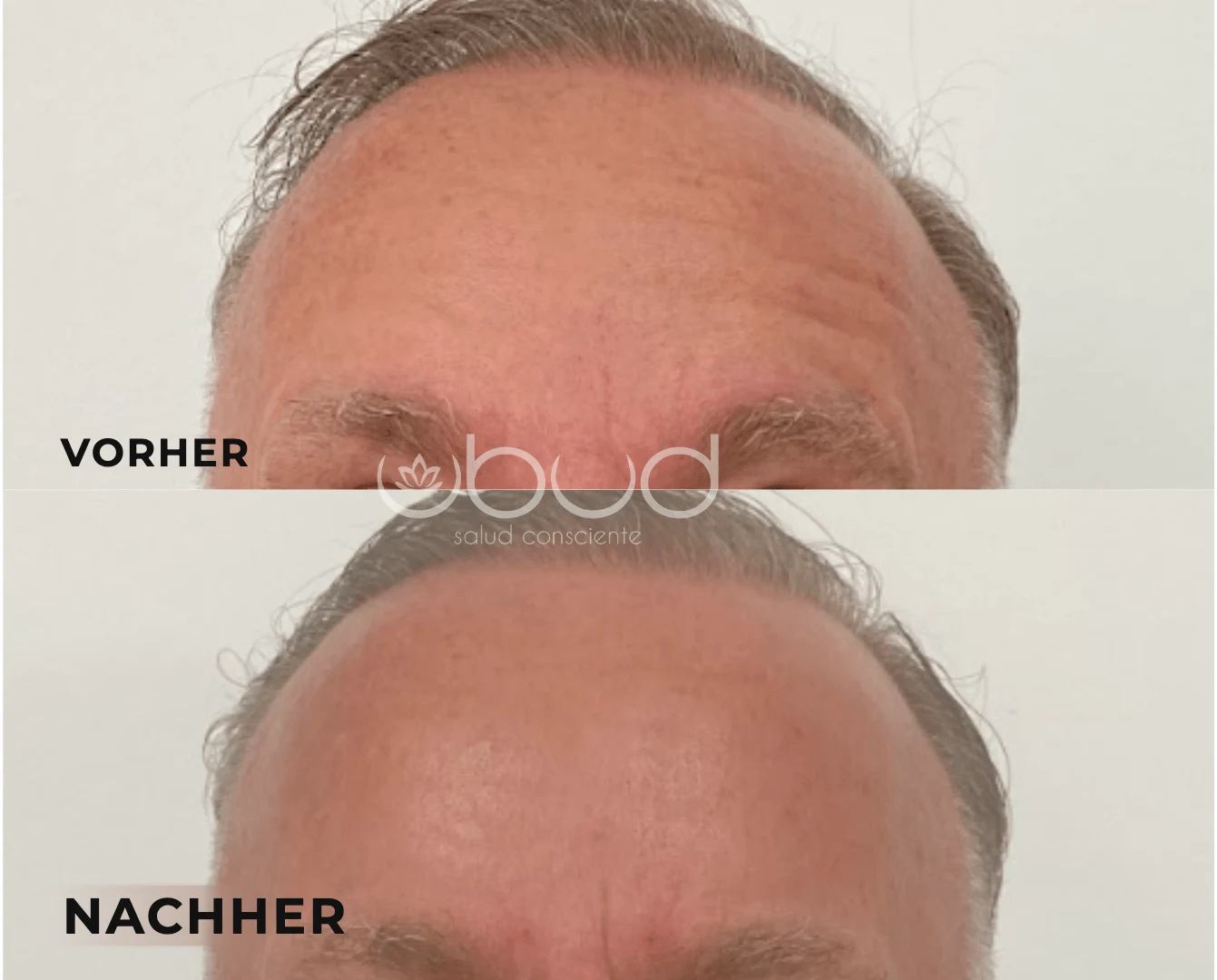 Antes y después de arrugas de la frente en Centro Ubud Torremolinos