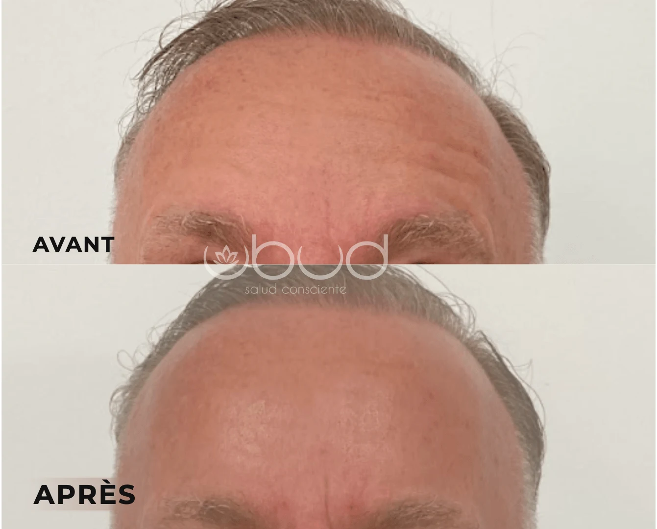 Antes y después de arrugas de la frente en Centro Ubud Torremolinos