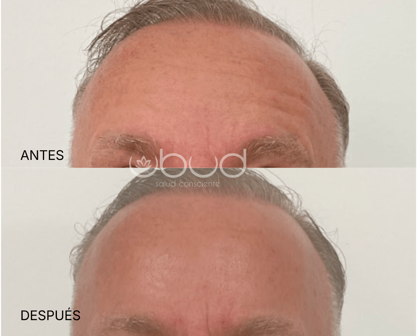 Antes y después de arrugas de la frente en Centro Ubud Torremolinos