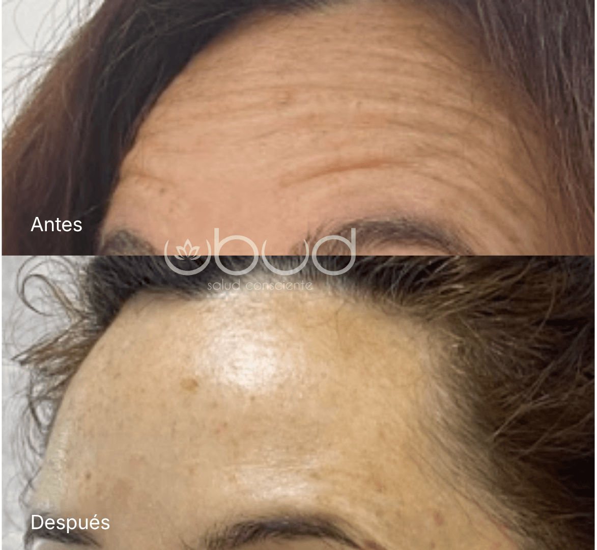 Antes y después de arrugas de la frente en Centro Ubud Torremolinos