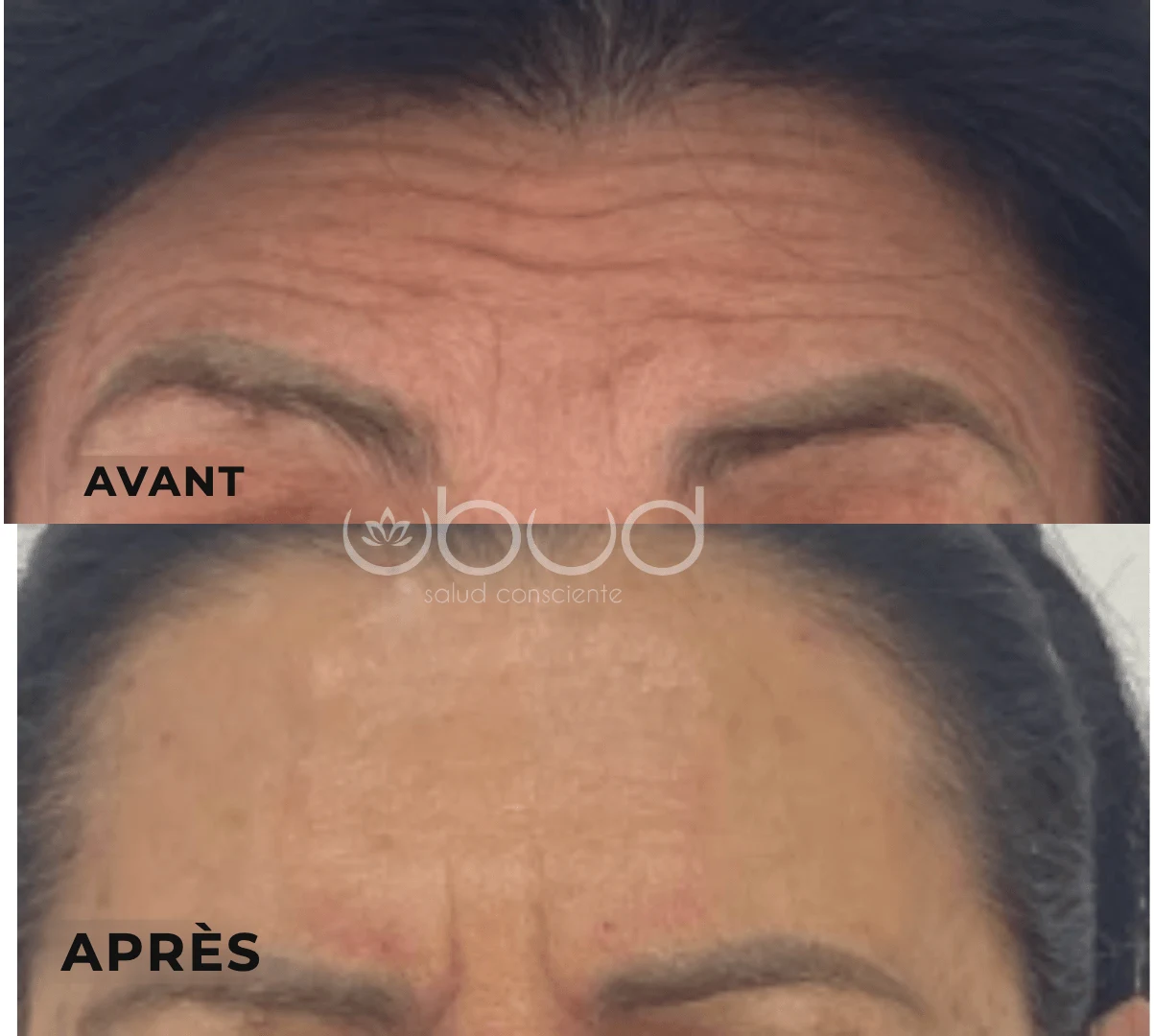 Antes y después de arrugas de la frente en Centro Ubud Torremolinos