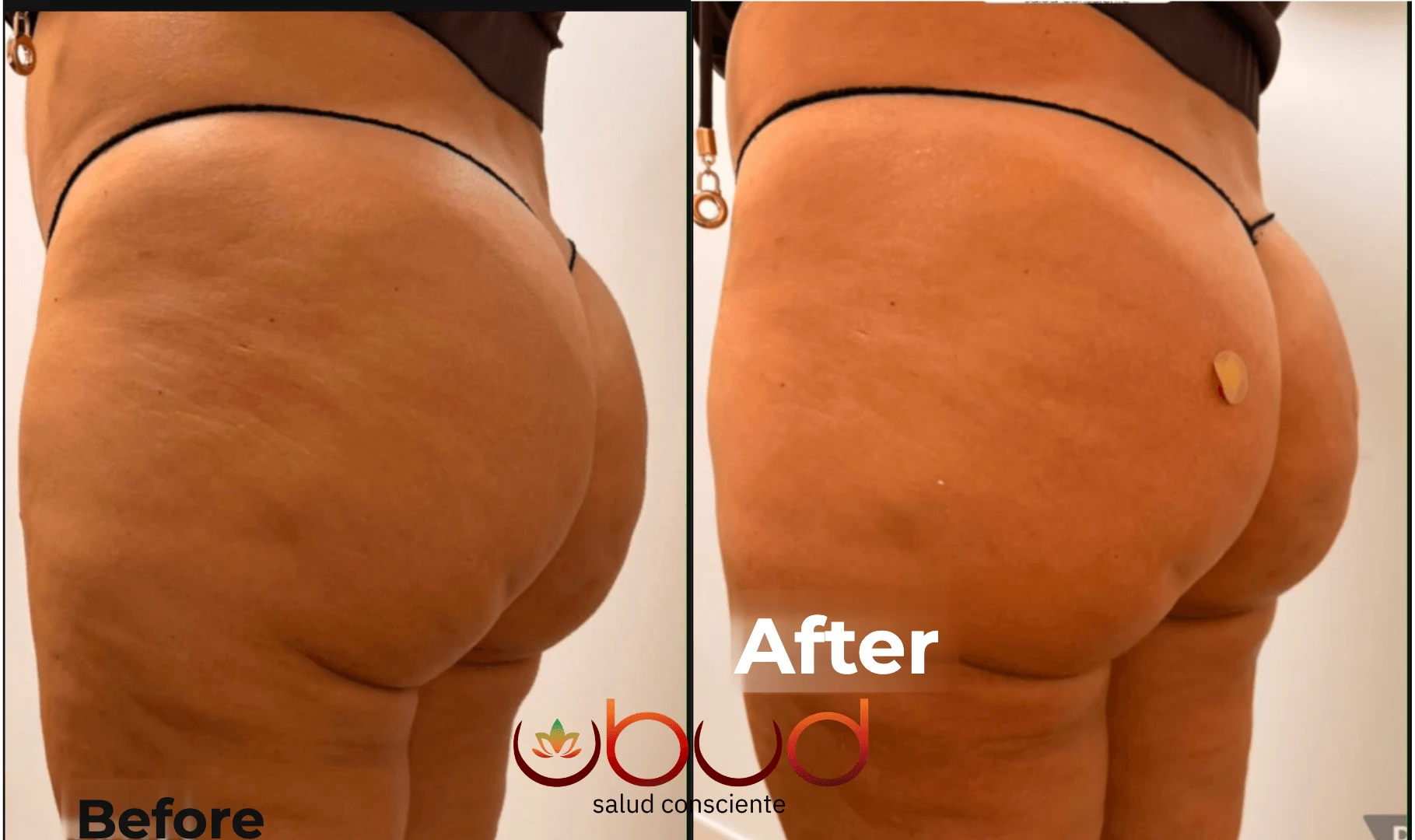 Antes y después de glúteos en Centro Ubud Torremolinos