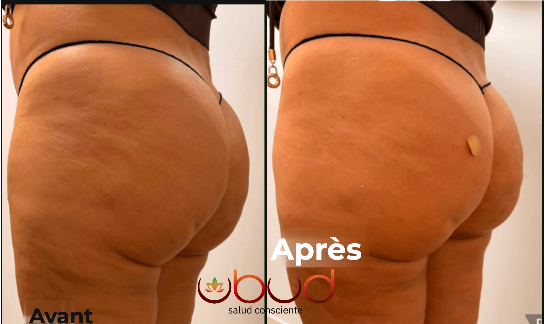 Antes y después de glúteos en Centro Ubud Torremolinos