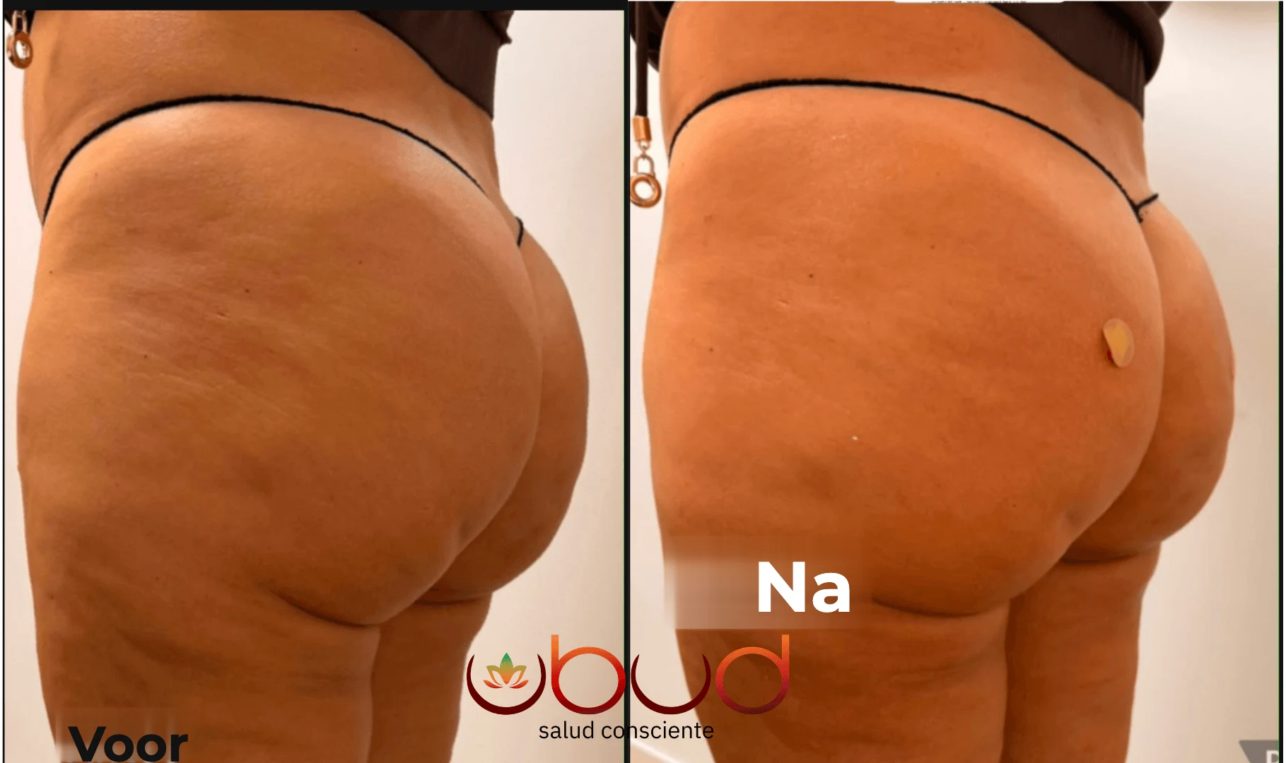 Antes y después de glúteos en Centro Ubud Torremolinos