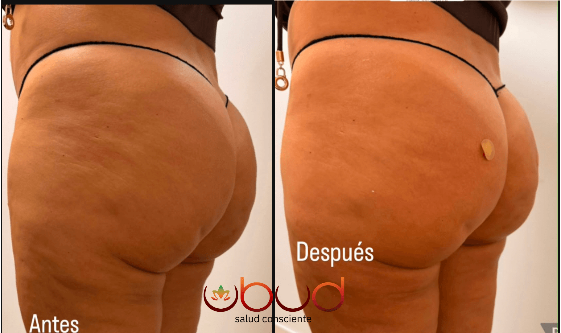 Antes y después de glúteos en Centro Ubud Torremolinos