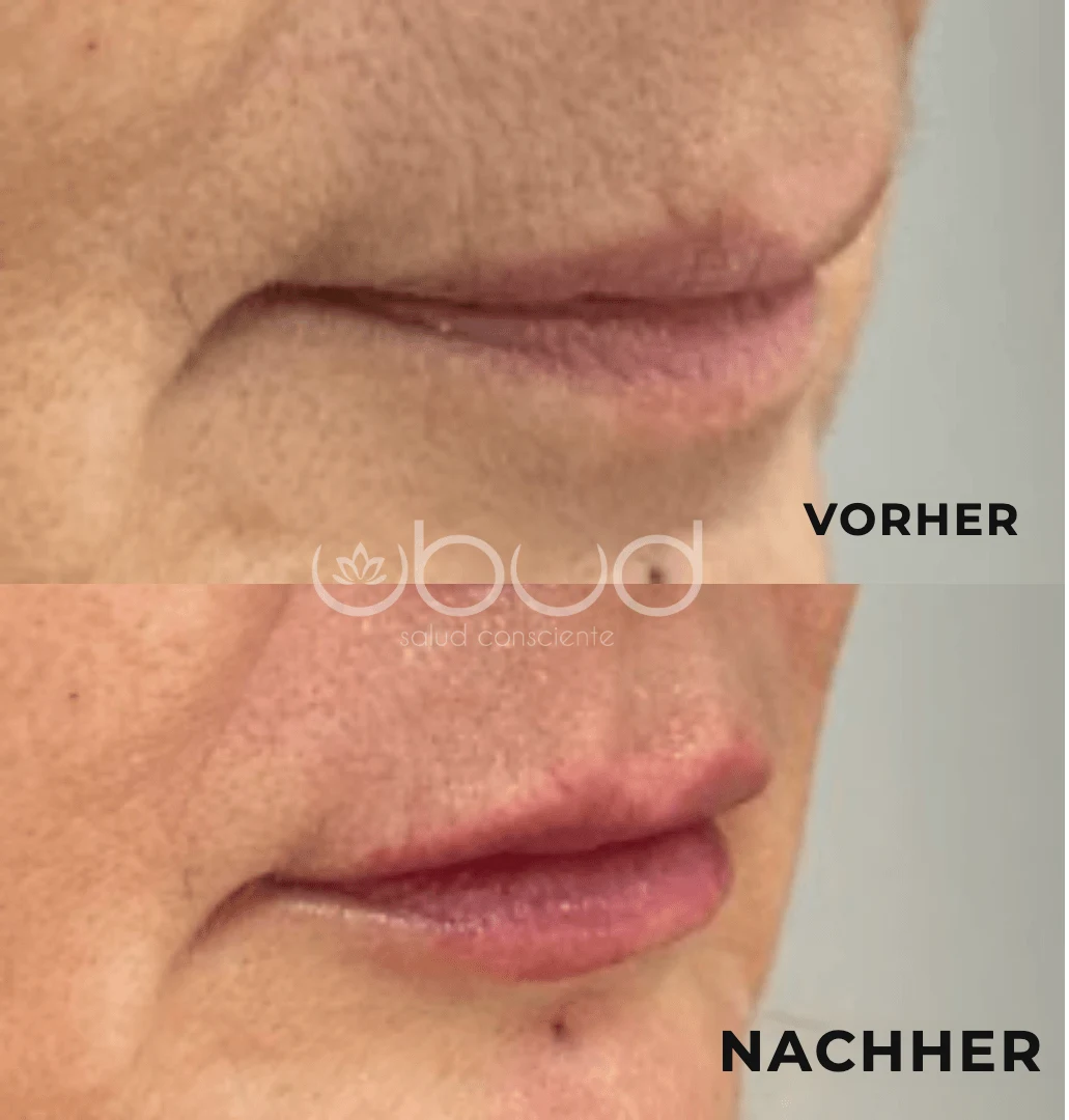 Antes y después de aumento de labios en Centro Ubud Torremolinos