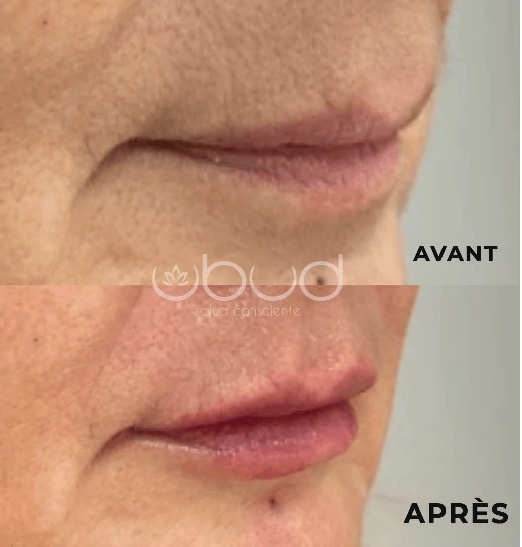 Antes y después de aumento de labios en Centro Ubud Torremolinos