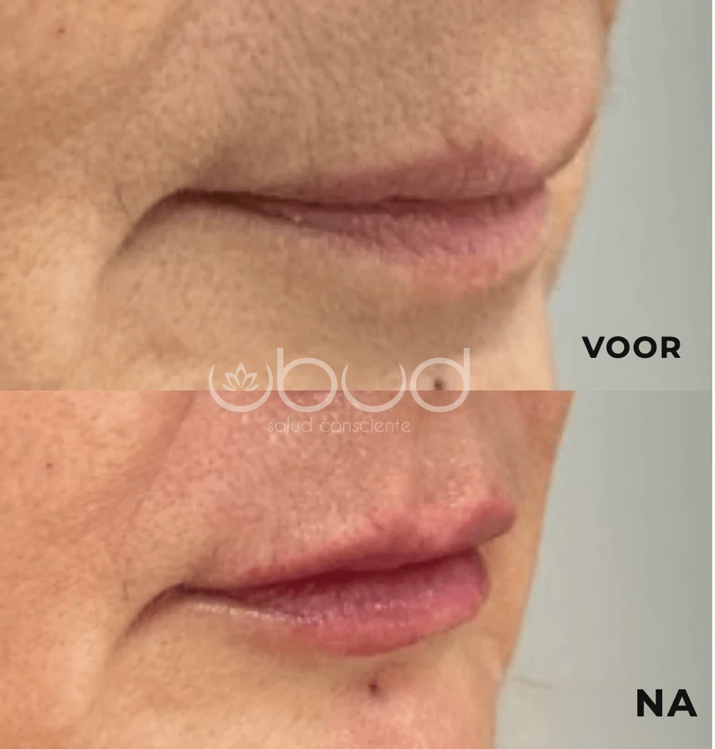 Antes y después de aumento de labios en Centro Ubud Torremolinos