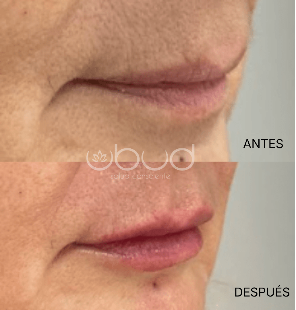 Antes y después de aumento de labios en Centro Ubud Torremolinos