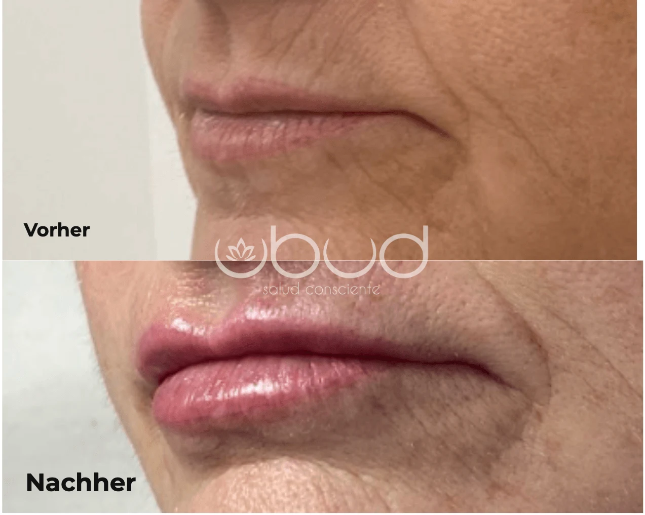 Antes y después de aumento de labios en Centro Ubud Torremolinos