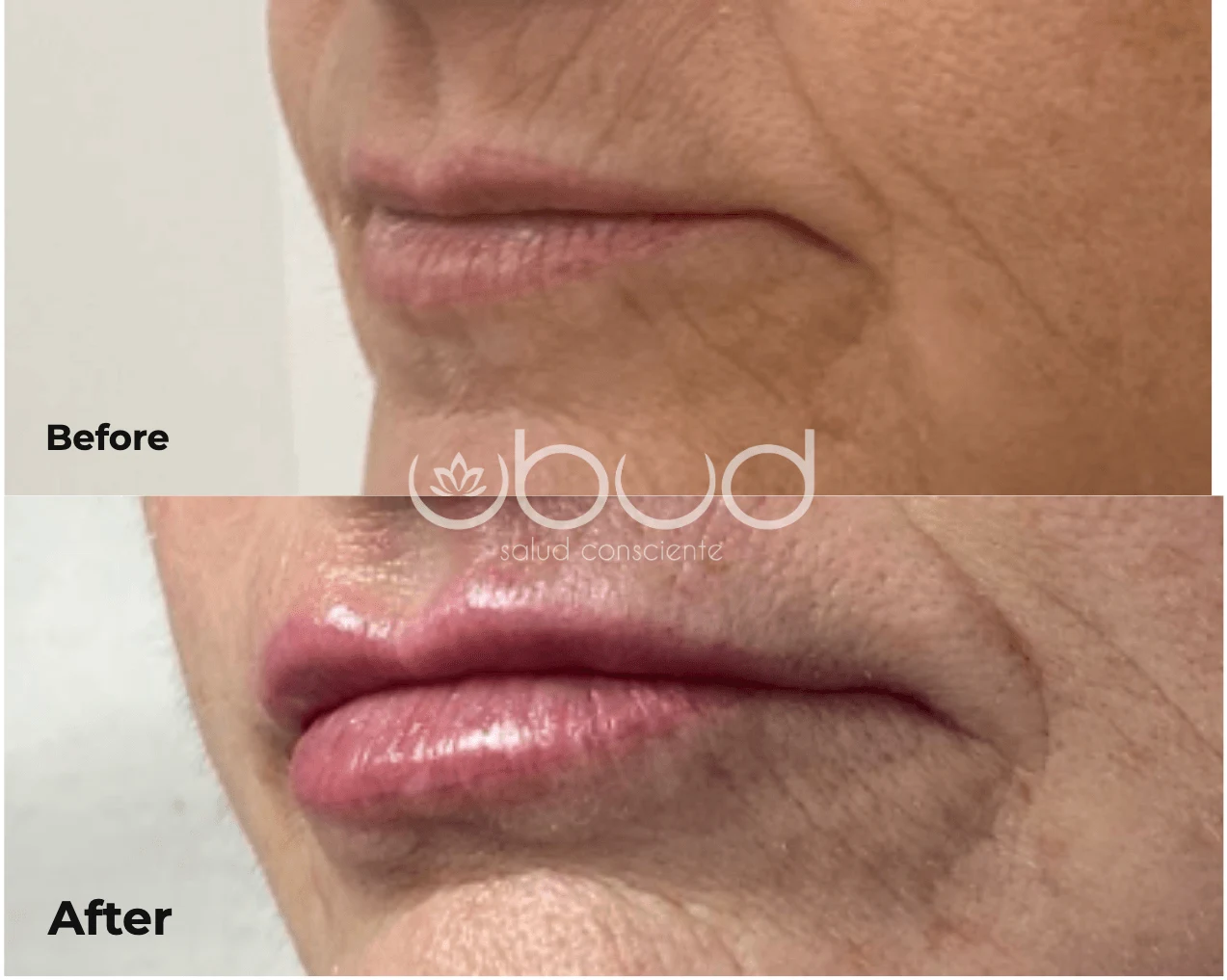 Antes y después de aumento de labios en Centro Ubud Torremolinos