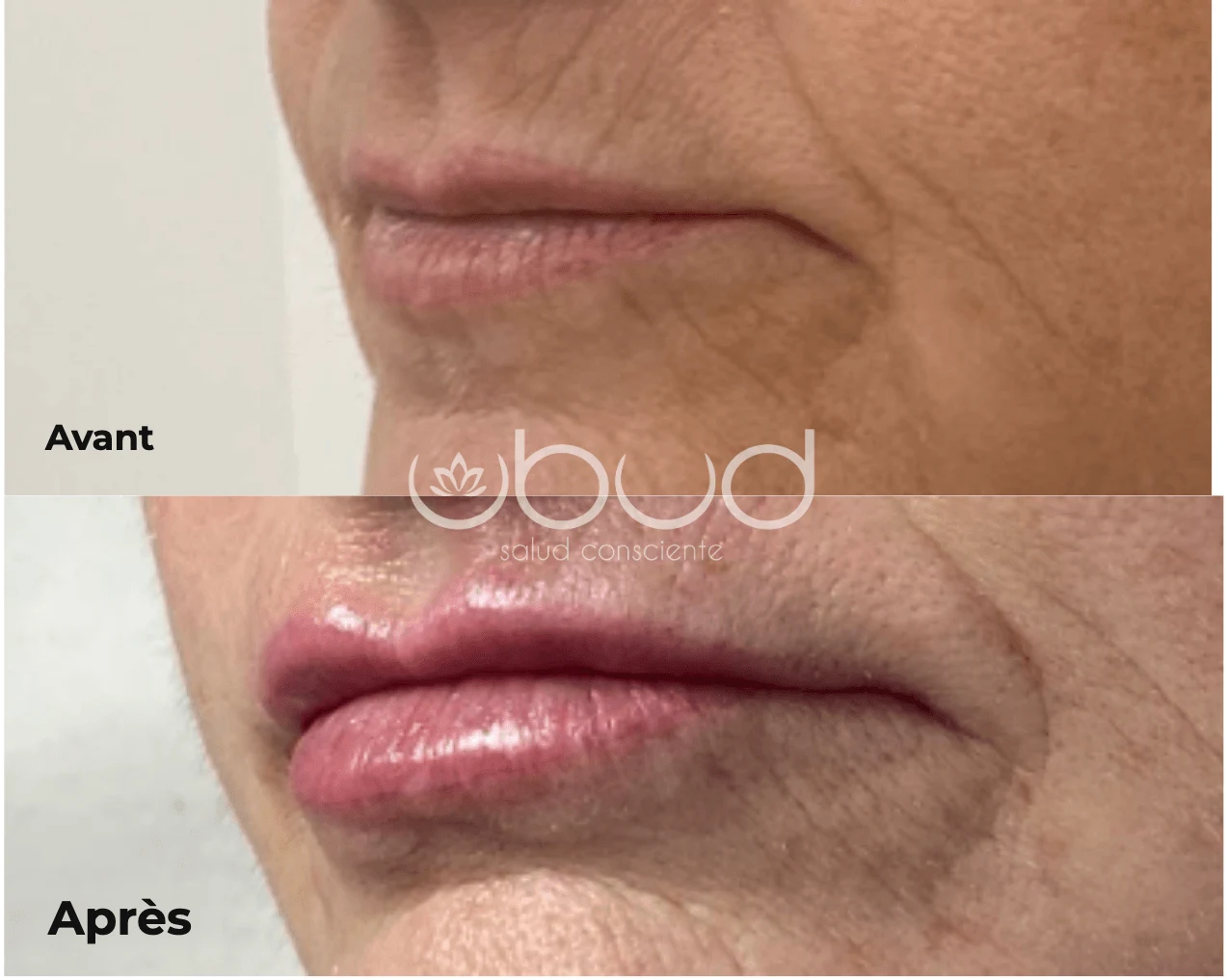 Antes y después de aumento de labios en Centro Ubud Torremolinos