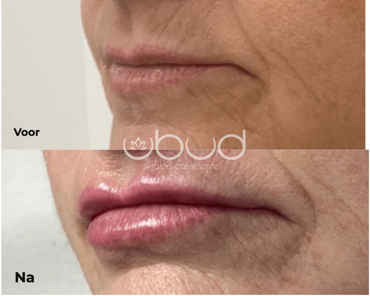Antes y después de aumento de labios en Centro Ubud Torremolinos