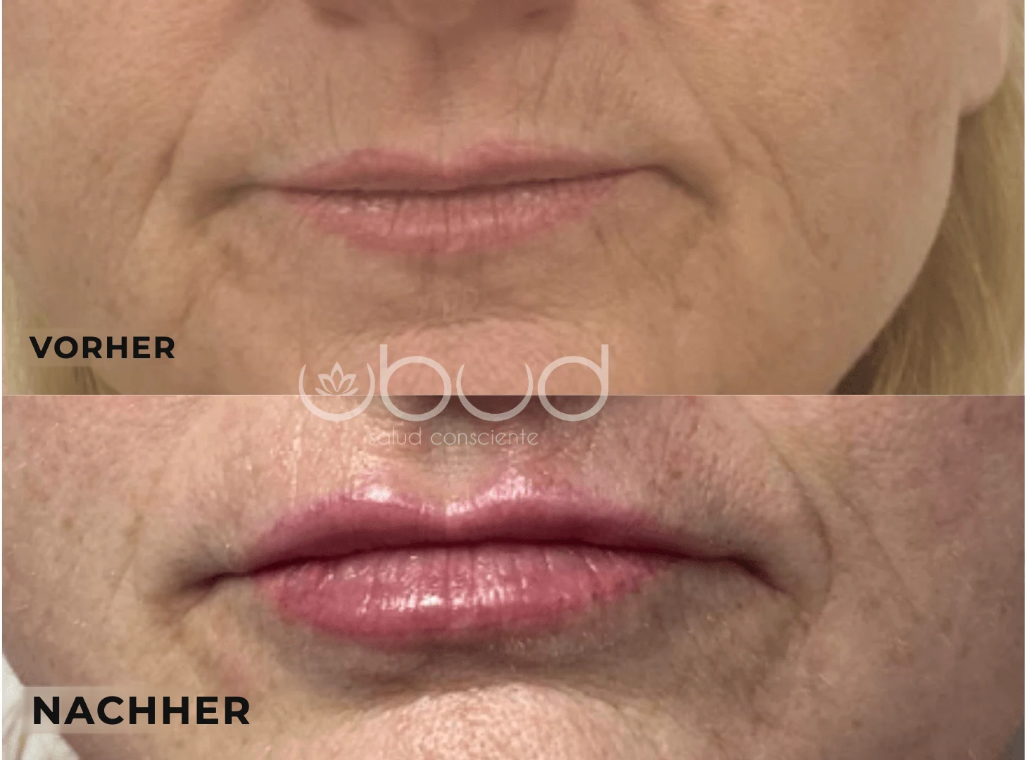 Antes y después de aumento de labios en Centro Ubud Torremolinos