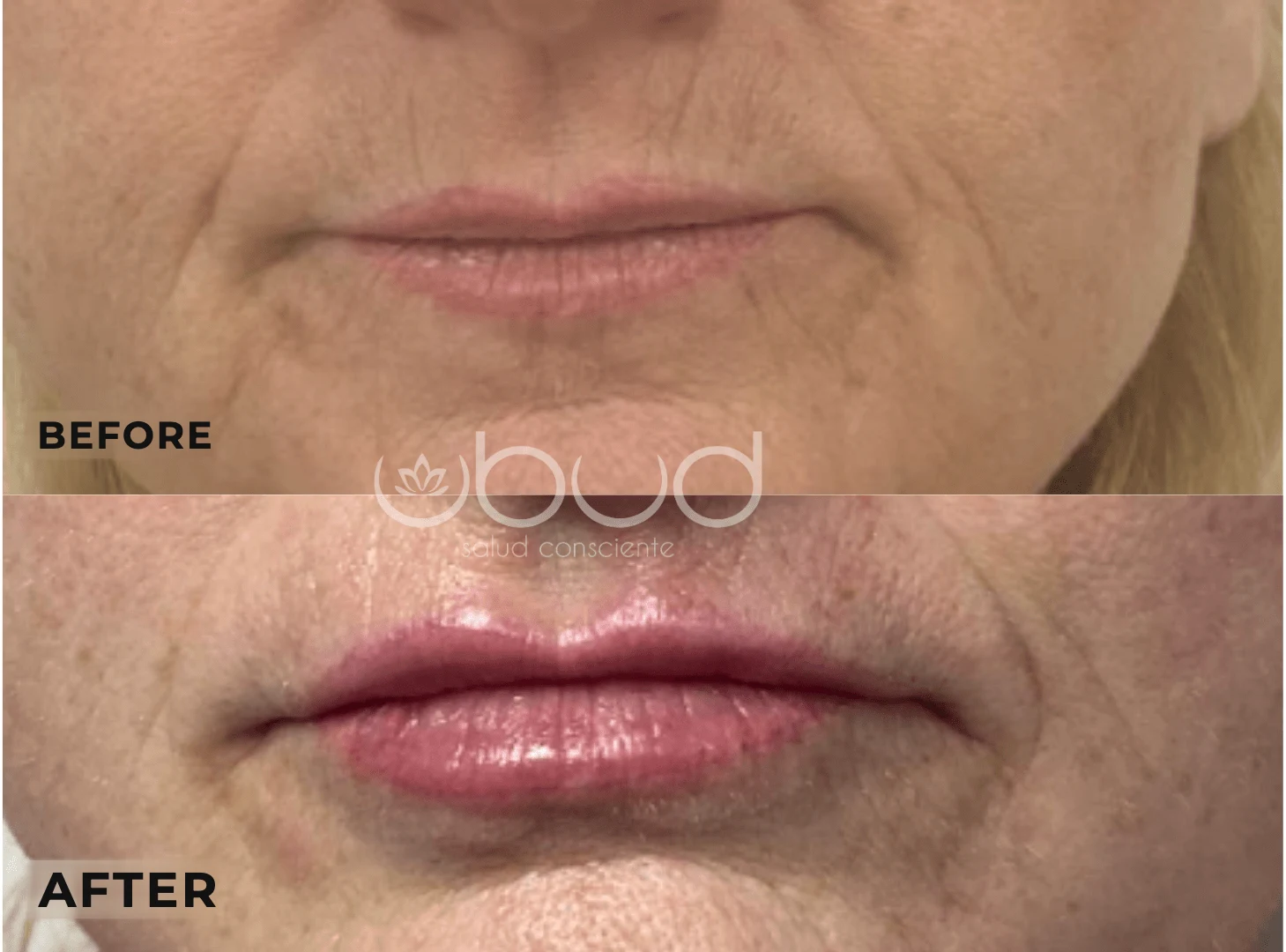 Antes y después de aumento de labios en Centro Ubud Torremolinos
