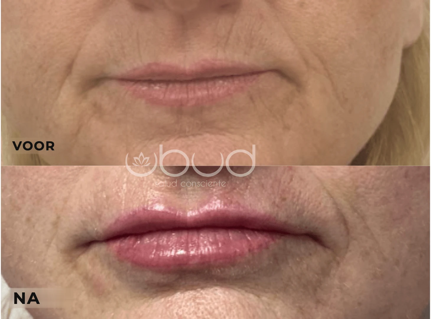 Antes y después de aumento de labios en Centro Ubud Torremolinos
