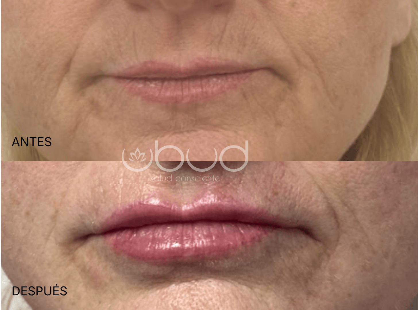 Antes y después de aumento de labios en Centro Ubud Torremolinos