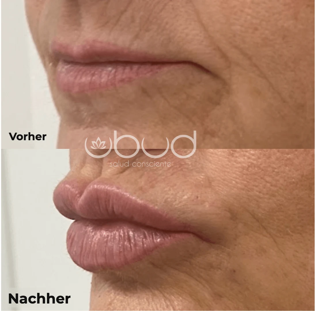 Antes y después de aumento de labios en Centro Ubud Torremolinos