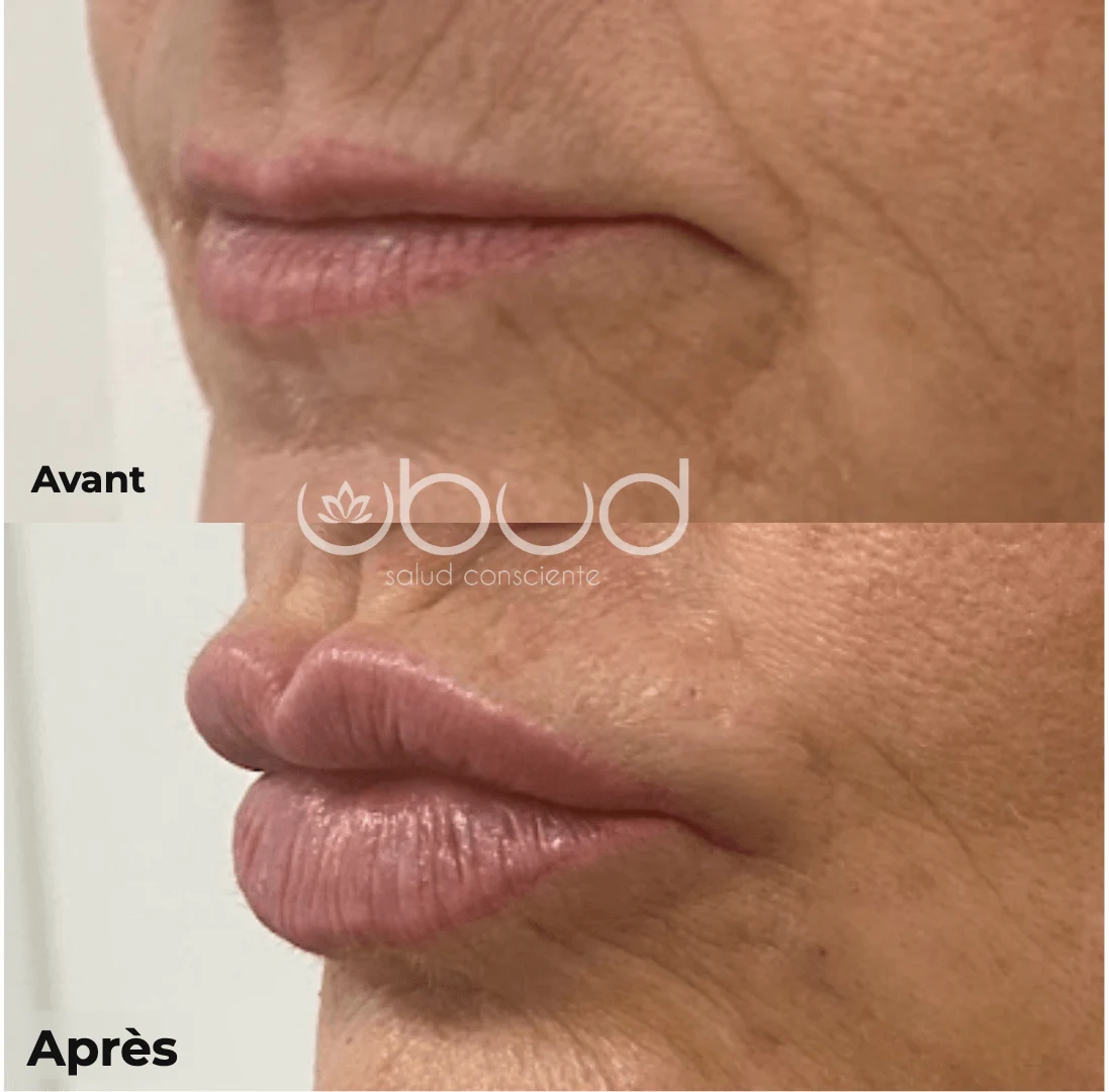 Antes y después de aumento de labios en Centro Ubud Torremolinos