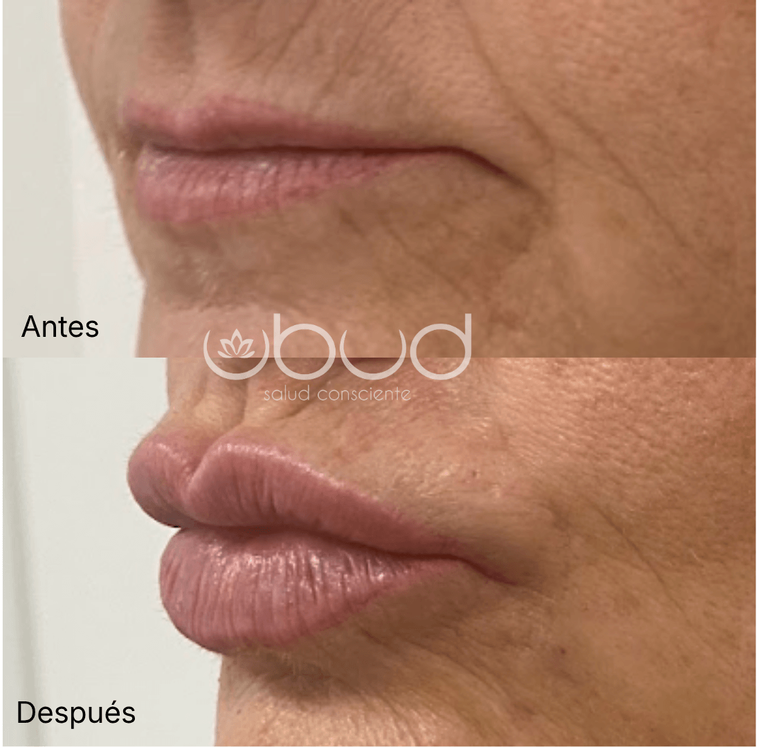 Antes y después de aumento de labios en Centro Ubud Torremolinos