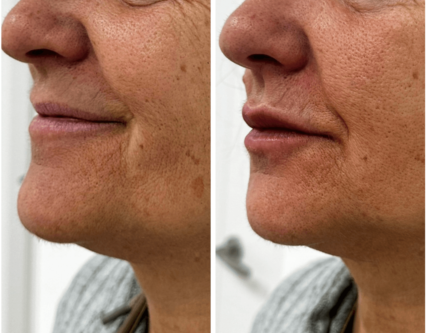 Antes y después de aumento de labios en Centro Ubud Torremolinos