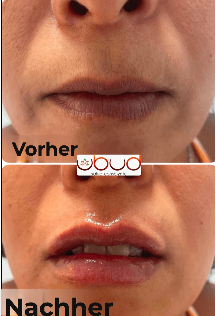 Antes y después de aumento de labios en Centro Ubud Torremolinos