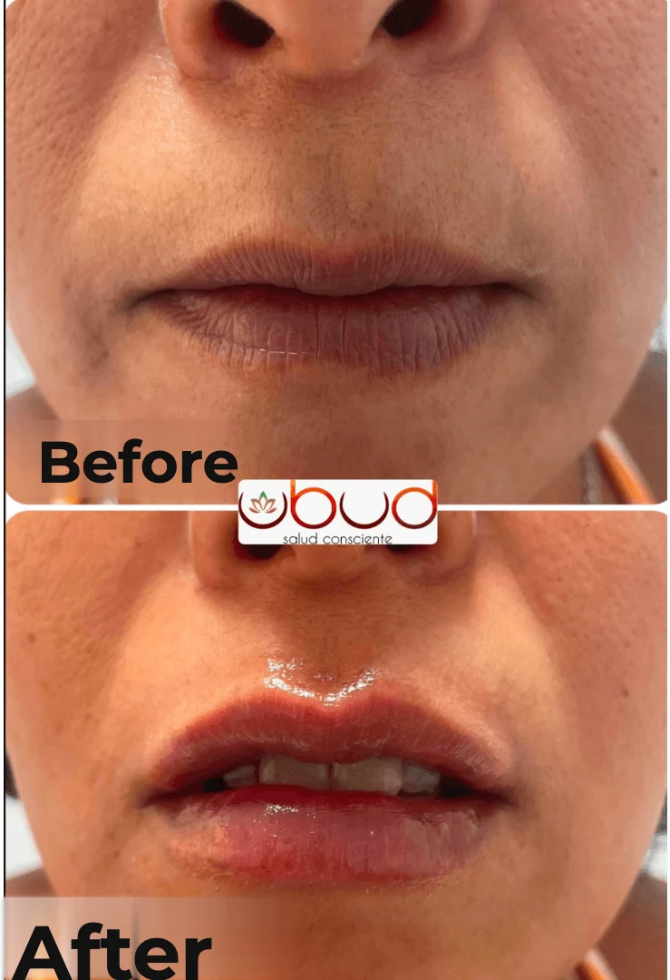 Antes y después de aumento de labios en Centro Ubud Torremolinos