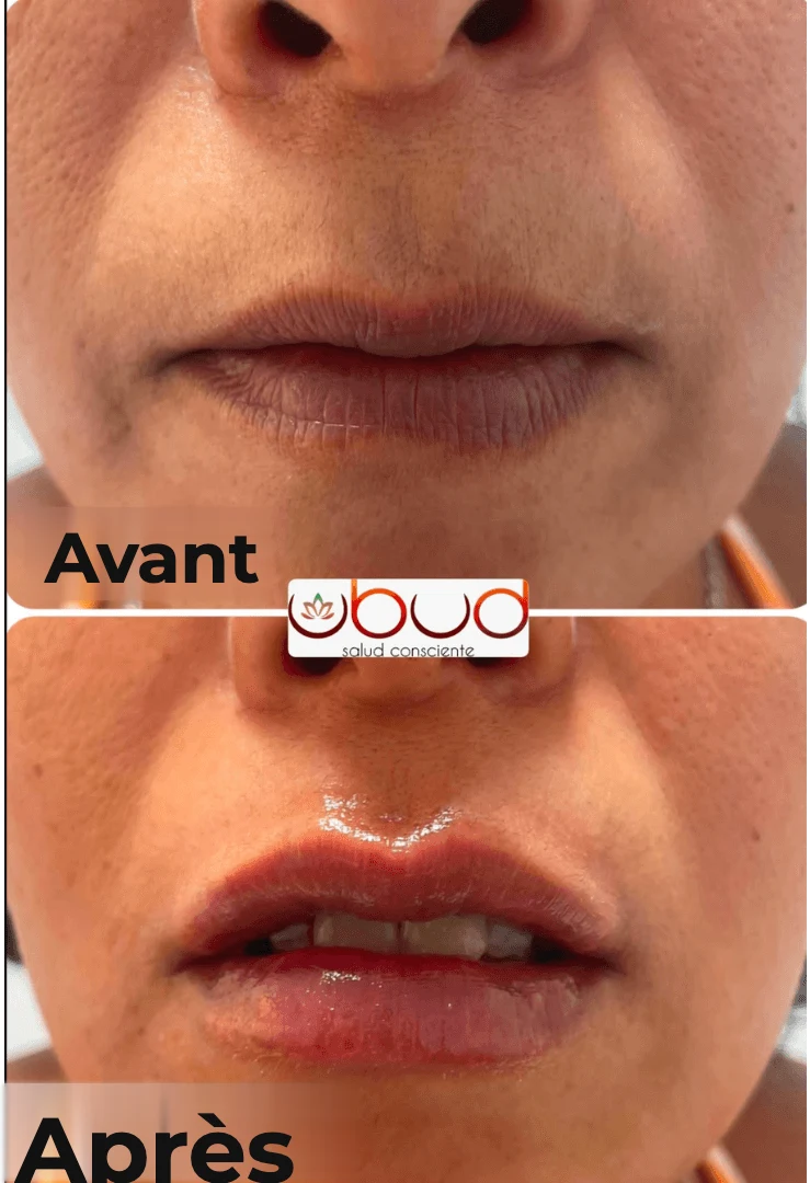 Antes y después de aumento de labios en Centro Ubud Torremolinos