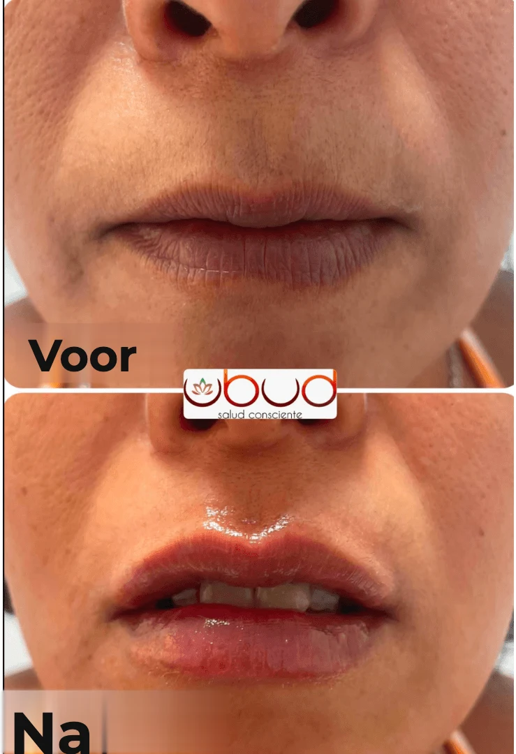 Antes y después de aumento de labios en Centro Ubud Torremolinos