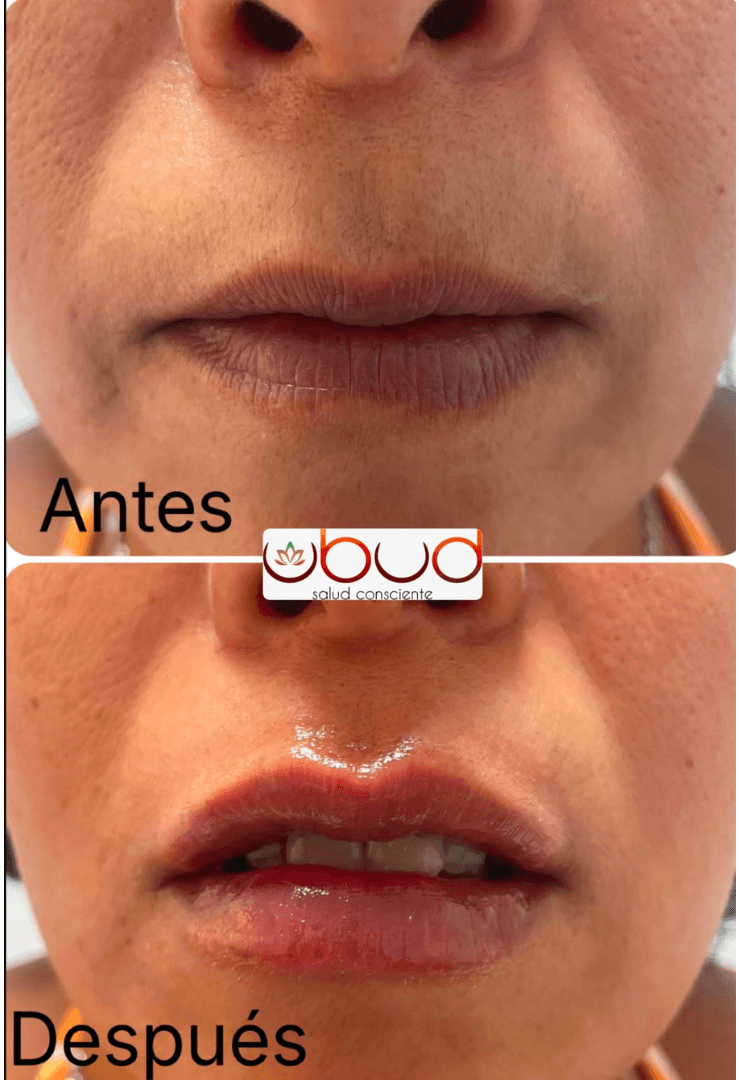 Antes y después de aumento de labios en Centro Ubud Torremolinos