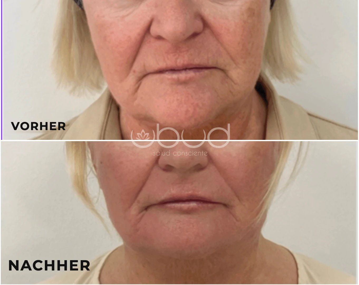 Antes y después de aumento de labios en Centro Ubud Torremolinos