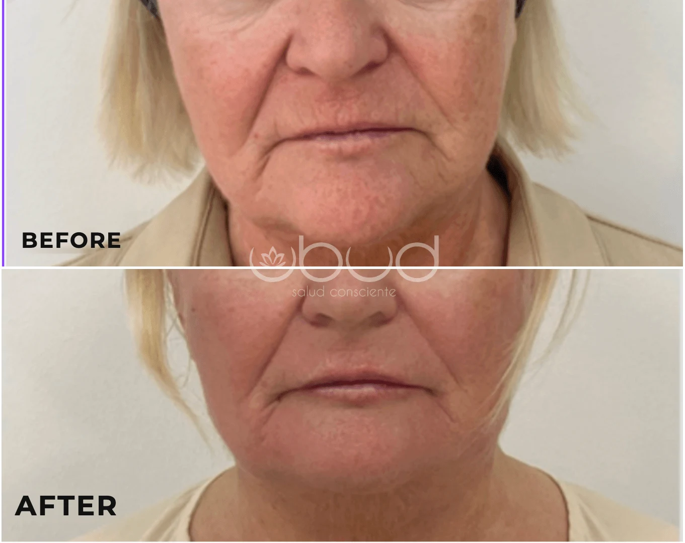 Antes y después de aumento de labios en Centro Ubud Torremolinos