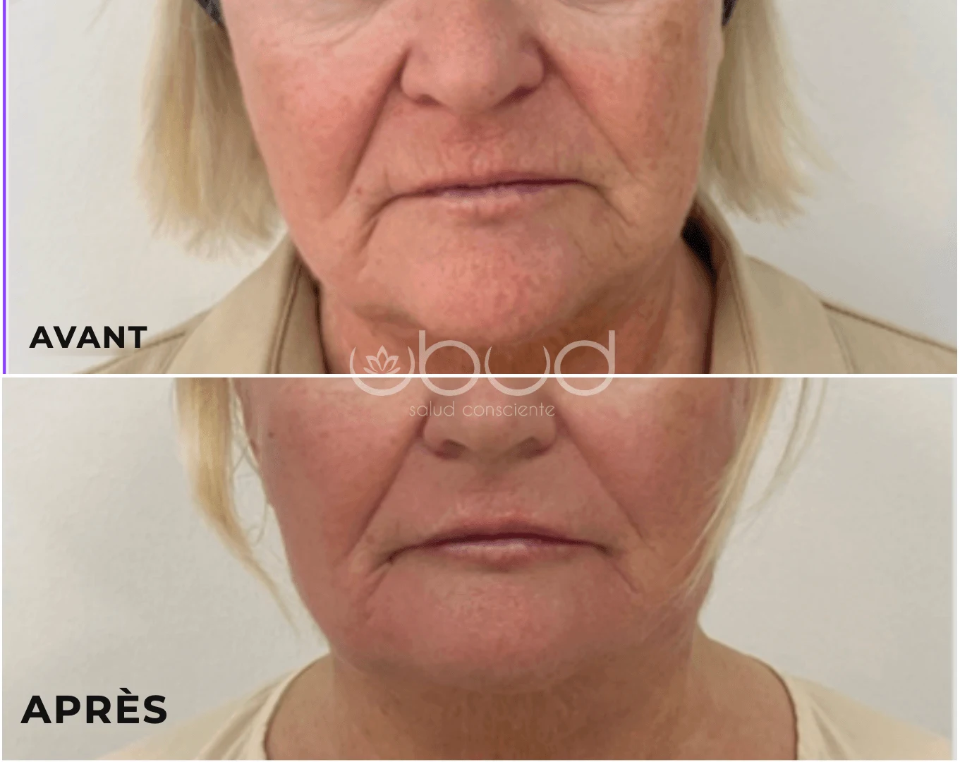 Antes y después de aumento de labios en Centro Ubud Torremolinos