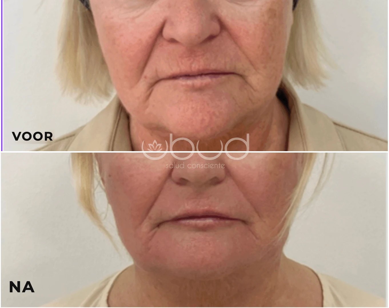 Antes y después de aumento de labios en Centro Ubud Torremolinos
