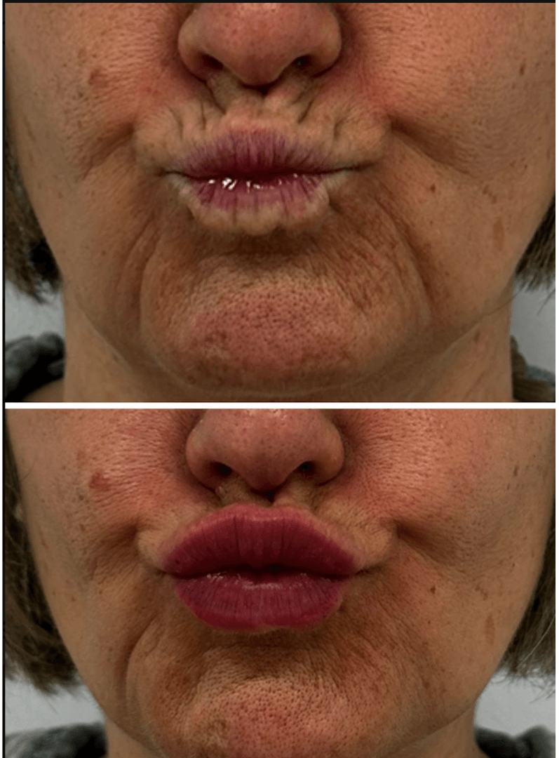 Antes y después de labios y código de barras en Centro Ubud Torremolinos