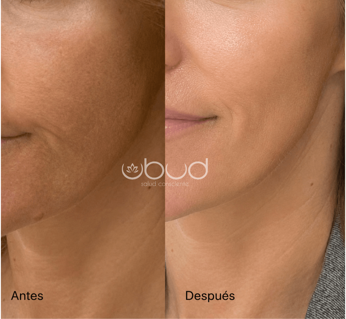 Antes y después de manchas en la piel en Centro Ubud Torremolinos