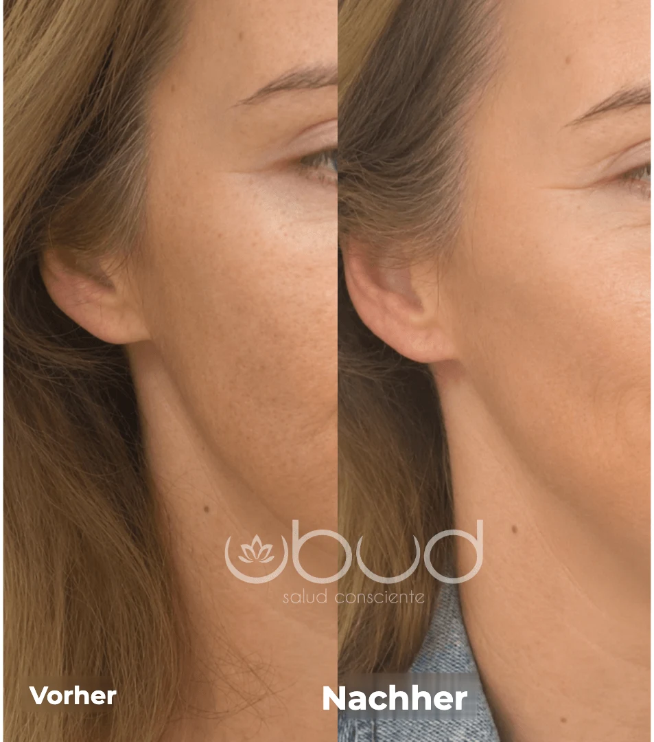 Antes y después de manchas en la piel en Centro Ubud Torremolinos