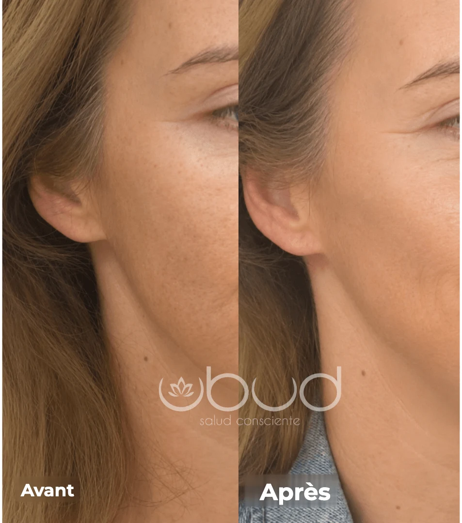 Antes y después de manchas en la piel en Centro Ubud Torremolinos