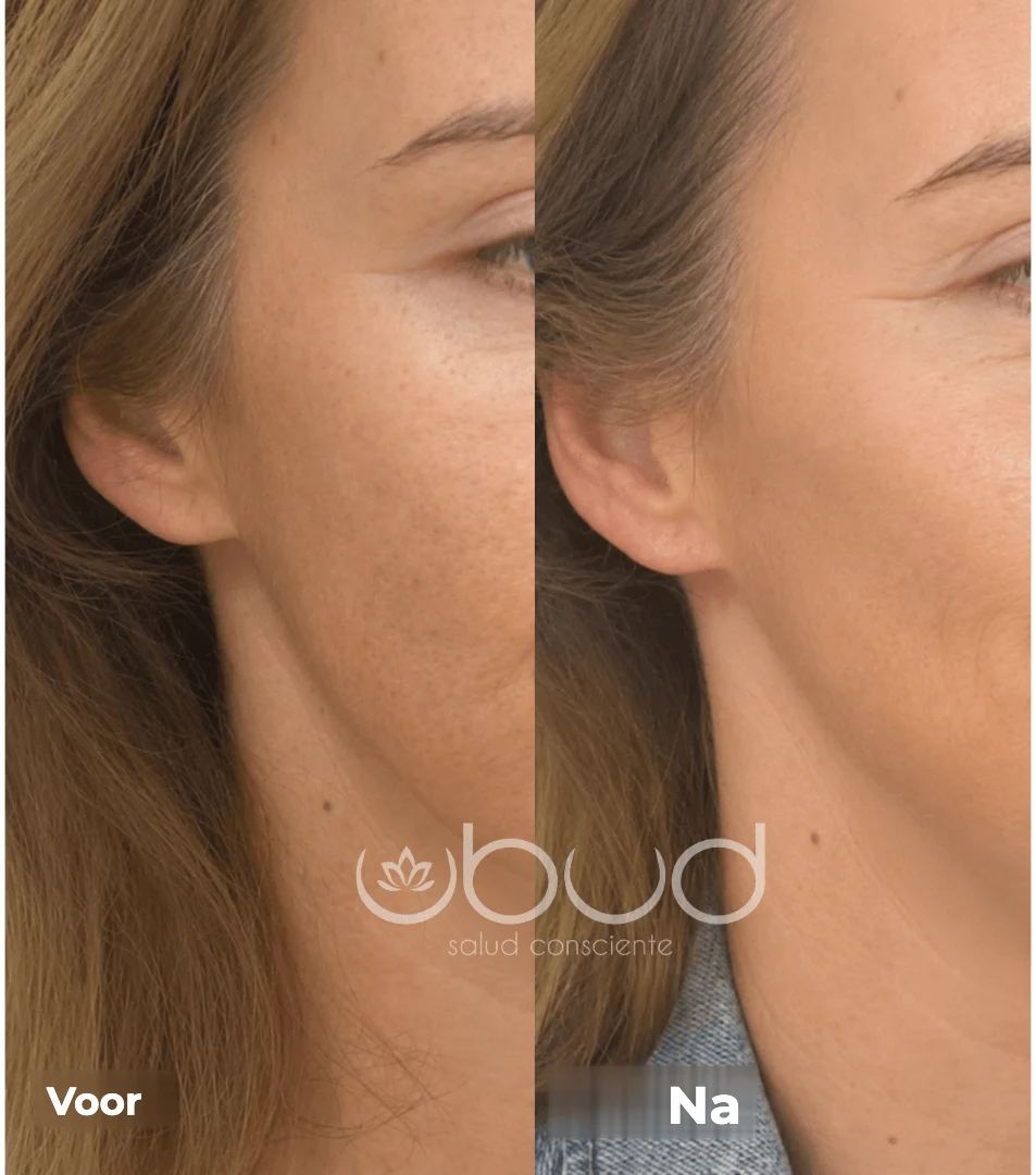Antes y después de manchas en la piel en Centro Ubud Torremolinos