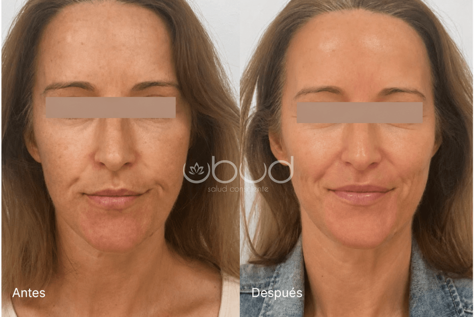 Antes y después de manchas y luminosidad en Centro Ubud Torremolinos