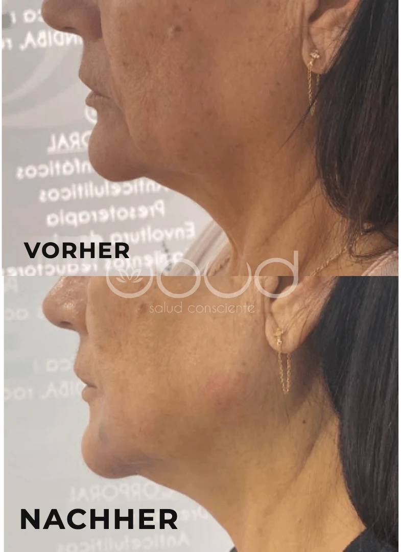Antes y después de marcación mandibular en Centro Ubud Torremolinos