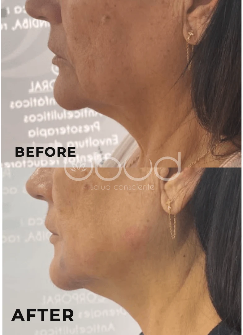 Antes y después de marcación mandibular en Centro Ubud Torremolinos